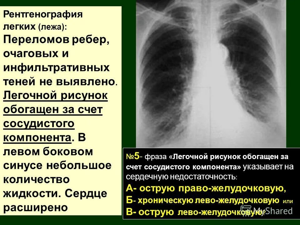 Без очаговых и инфильтративных изменений. Легочной рисунок на рентгенограмме. Усилен сосудистый рисунок легких. Флюорография легочный рисунок. Легочный рисунок деформирован.