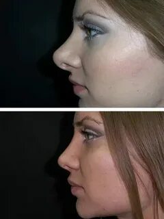 Ринопластика kai angel osu