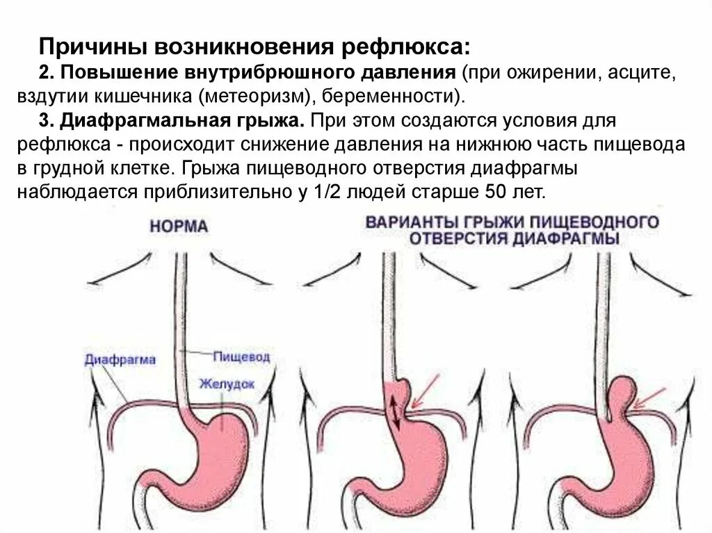 Упражнения при рефлюксе. Гастроэзофагеальная рефлюкс-болезнь. Факторы ГЭРБ. Грыжа пищеводного отверстия, ГЭРБ.