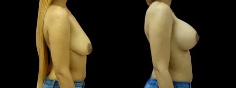 Case: #156 Age: 30 Procedure: Breast Lift and Augmentation with 375 CC sili...