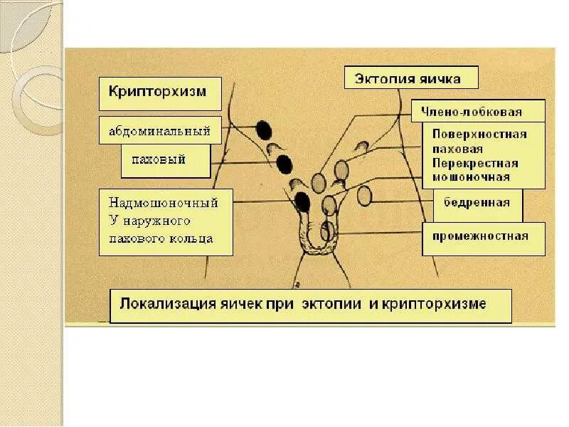 Крипторхизм что это такое. Крипторхизм и эктопия яичка. крипторхизм классификация. локализация яичка при крипторхизме.