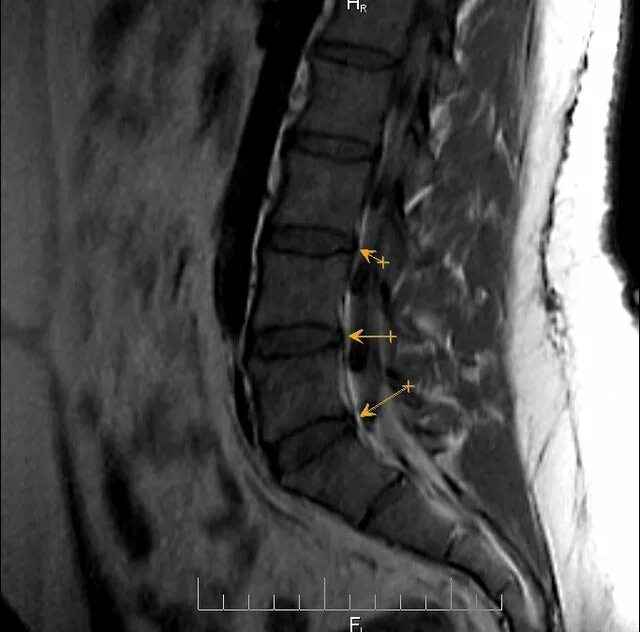 L4 l5 отдел позвоночника протрузия. Протрузия l4-l5. Протрузии l4 l5. Протрузия диска l4 l5 что это такое. Протрузии l4-s1.