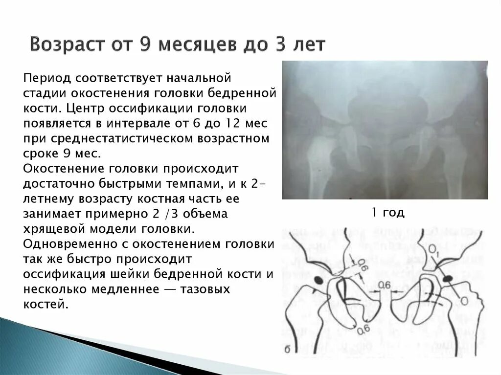 Норма тазобедренного сустава у новорожденных. Антеторсия тазобедренных суставов. ядра окостенения тазобедренного сустава возрастные. схема тбс дисплазия. ядра окостенения тазобедренных суставов у детей норма в 3 месяца.