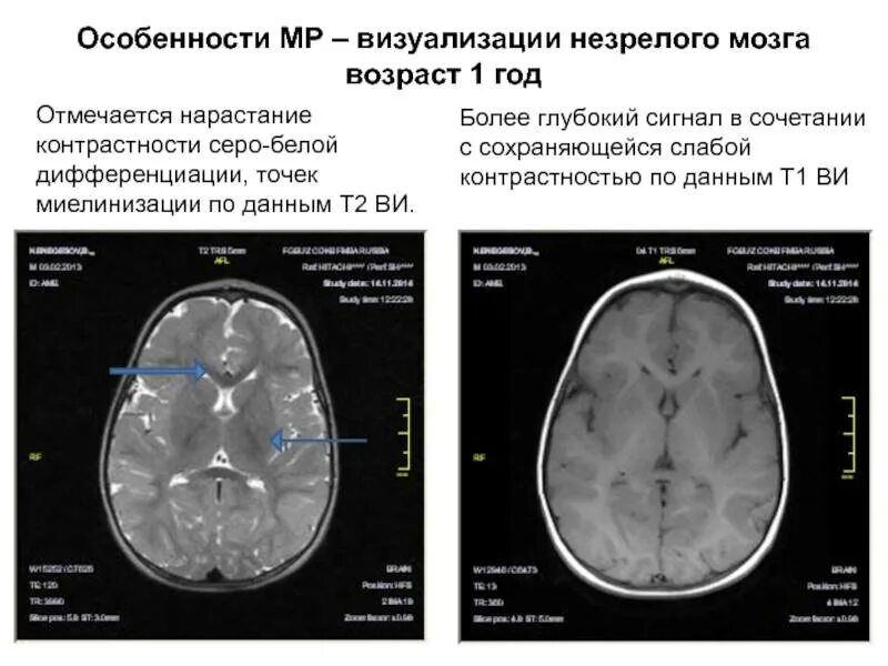Сдвг на мрт. Мрт мозга что покажет у ребенка. Мрт ребенка снимок. Мозг ребенка норма мрт. Мрт ребенка снимок.