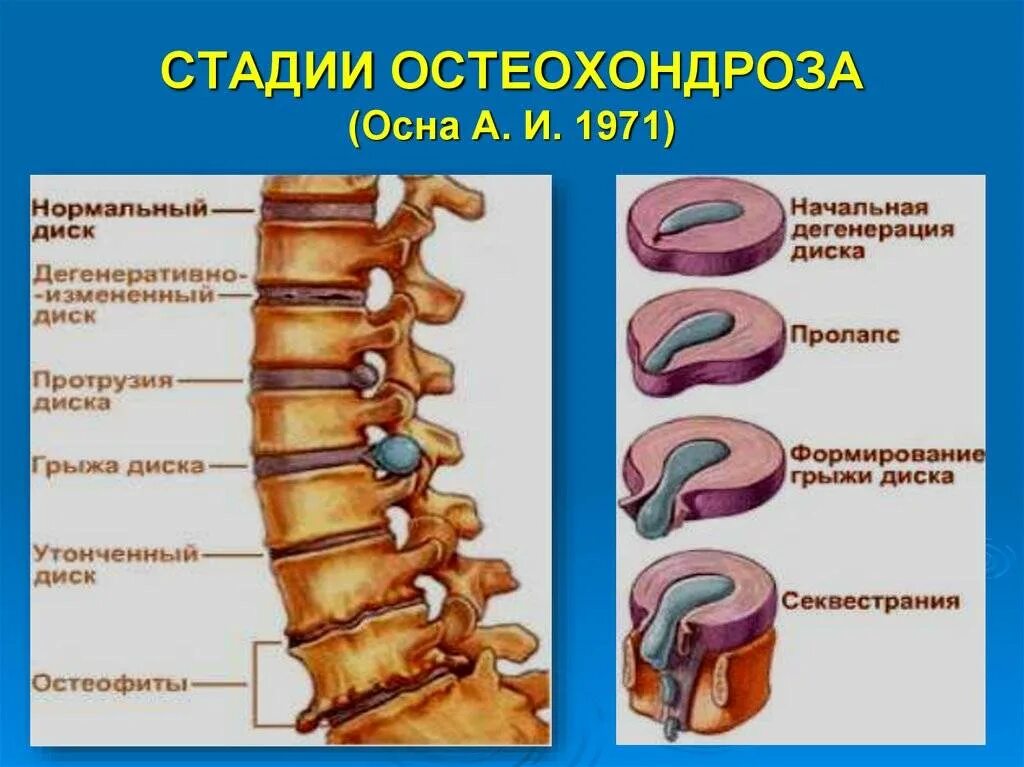 Патогенетические стадии остеохондроза позвоночника. Патогенез стадий остеохондроза. Остеохондроз 1-2 степени грудного отдела. Этапы развития остеохондроза позвоночника.