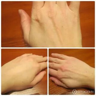 Аллергия на орехи
