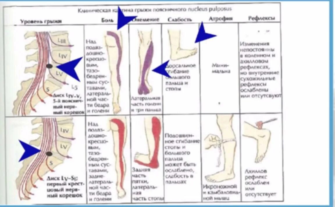 Боль в ногах от бедра до стопы. Радикулопатия корешка l5 это. Радикулопатия корешка l5 s1. Корешковый синдром бедра. Чудо точка которая избавит от боли в ягодице ногах и пояснице.