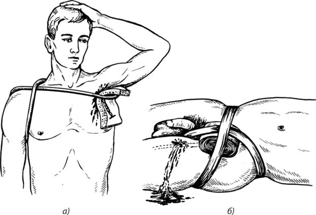 Бедренная перевязка. Наложение жгута на подмышечную артерию. Наложение жгута при повреждении подмышечной артерии. Техника наложения жгута при ранении сонной артерии. Техника наложения кровоостанавливающего жгута на шею.