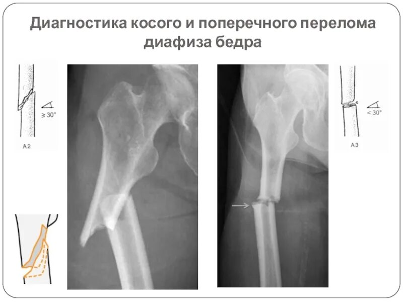 Диафизарный перелом бедра рентген. Косой перелом диафиза бедренной кости. Перелом диафиза бедренной кости. Перелом диафиза бедра рентген. Перелом средней трети диафиза плечевой кости.