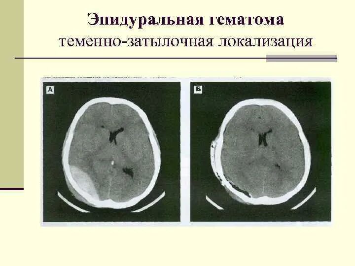 Эпидуральная гематома на кт. Эпидуральная гематома локализация. Эпидуральная гематома на УЗИ. Гематома затылочной области. Гематома мозга операция