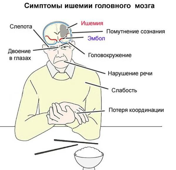 Ишемия головного мозга у пожилых людей. Ишемия головного мозга проявления. ишемия головного мозга 2 степени симптомы. хроническая ишемия головного мозга симптомы. ишемия головного мозга у взрослых.