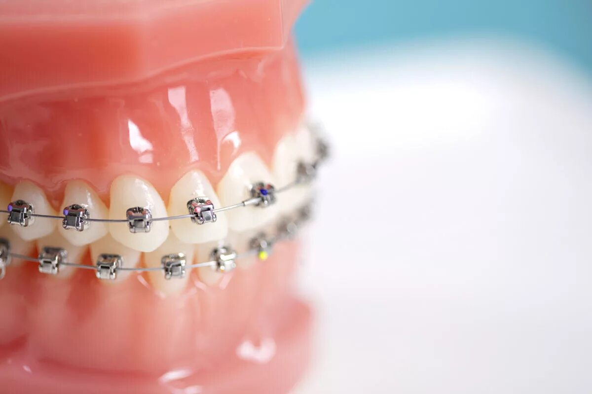 установка брекетов волгоград