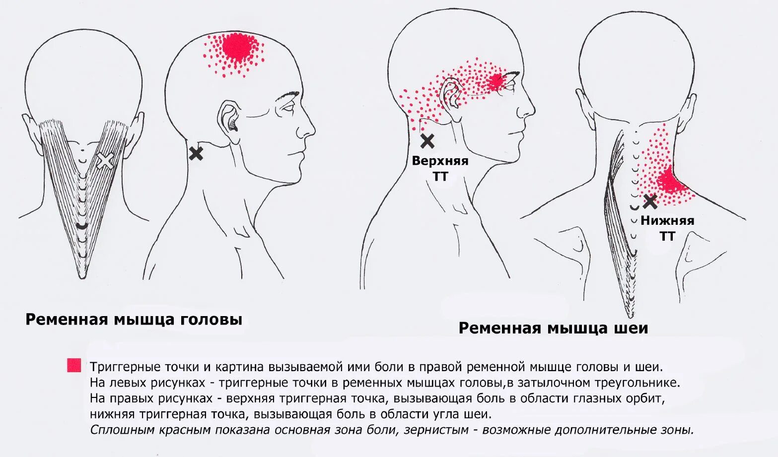 Голова болит сбоку. Триггерные точки ременных мышц головы и шеи. Ременная мышца головы триггерные точки. Ременная мышца шеи триггерные точки. Подзатылочные мышцы триггерные точки.