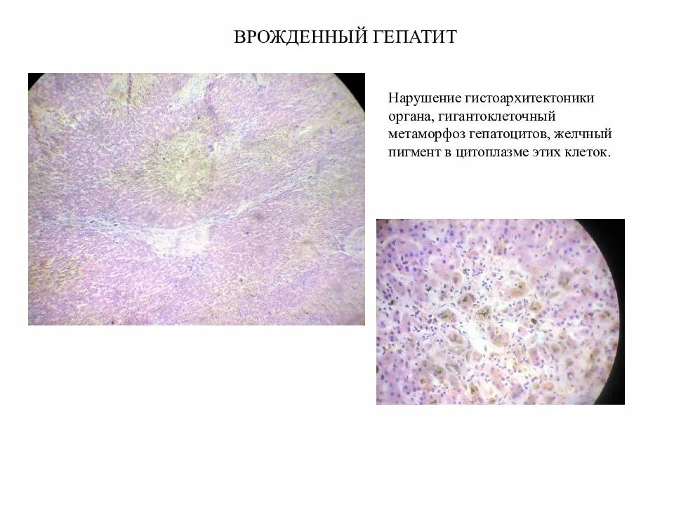 Диффузный гепатит. Мускатная печень патанатомия макропрепарат. Венозное полнокровие макропрепарат. Гепатит печени патанатомия. Венозное полнокровие печени мускатная печень.