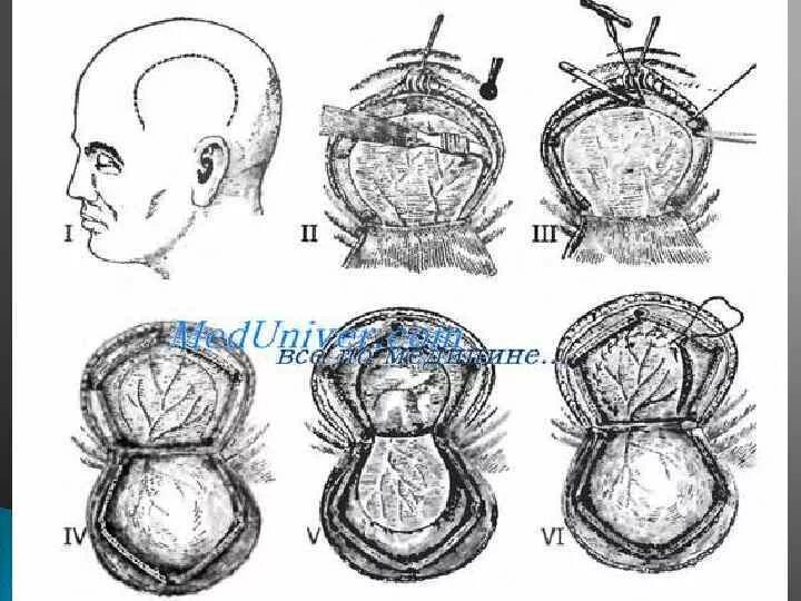 Костно-пластическая Трепанация черепа Вагнера Вольфа. Костно пластическая Трепанация черепа по Вагнеру Вольфу. Бифронтальная Трепанация черепа. Трепанация черепа Оперативная хирургия.