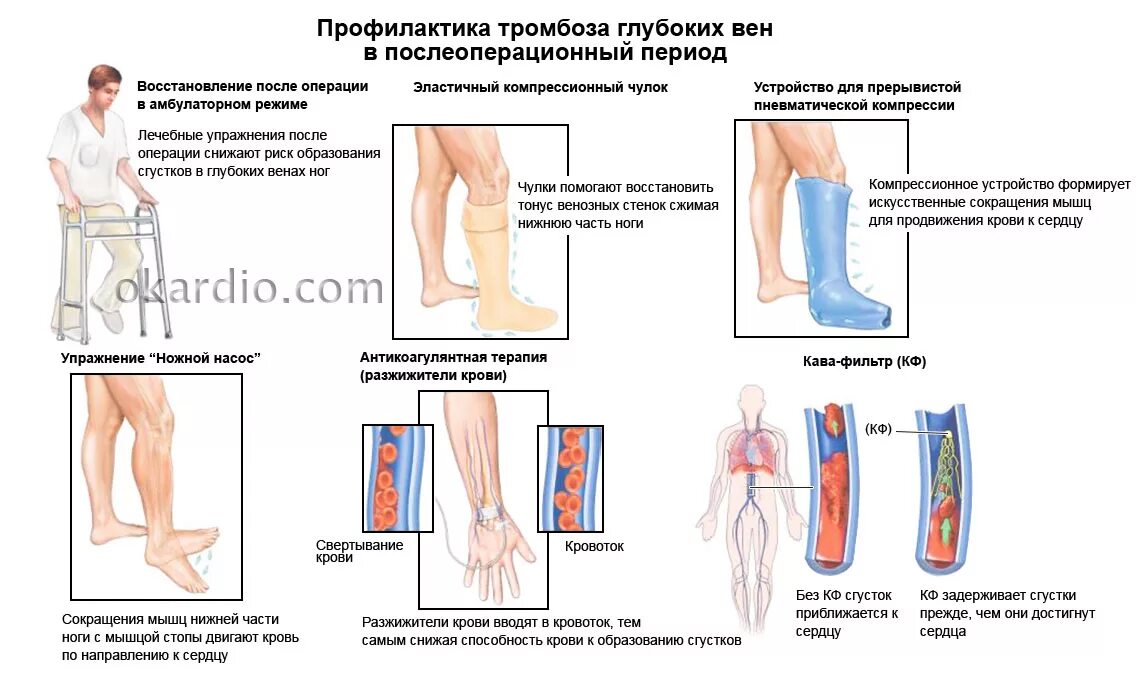 Операции при тромбозе