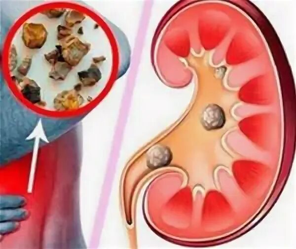 Что делать если камень застрял в мочеточнике. Камень в почечной лоханке препараты. Отросчатые камни в лоханке.