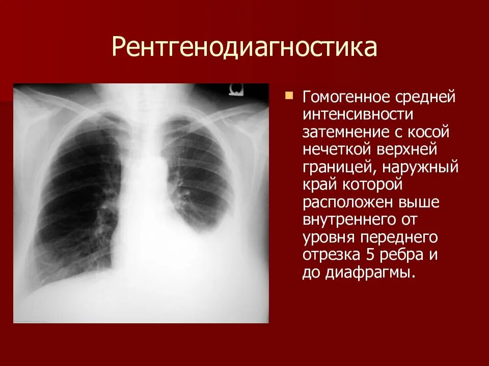 Затемнение верхней доли легкого. Гомогенное затемнение легкого что это такое. Гомогенное затемнение легких на рентгене. Гомогенное затемнение легких что это. Гомогенное затемнение доли легкого.