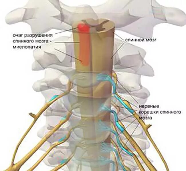 Корешковые нервы в пояснице. Шейная миелопатия. Корешки спинного мозга шейный отдел. • Опухоли спинного мозга, позвоночника, нервных Корешков;. Шейный отдел позвоночника спинной мозг.