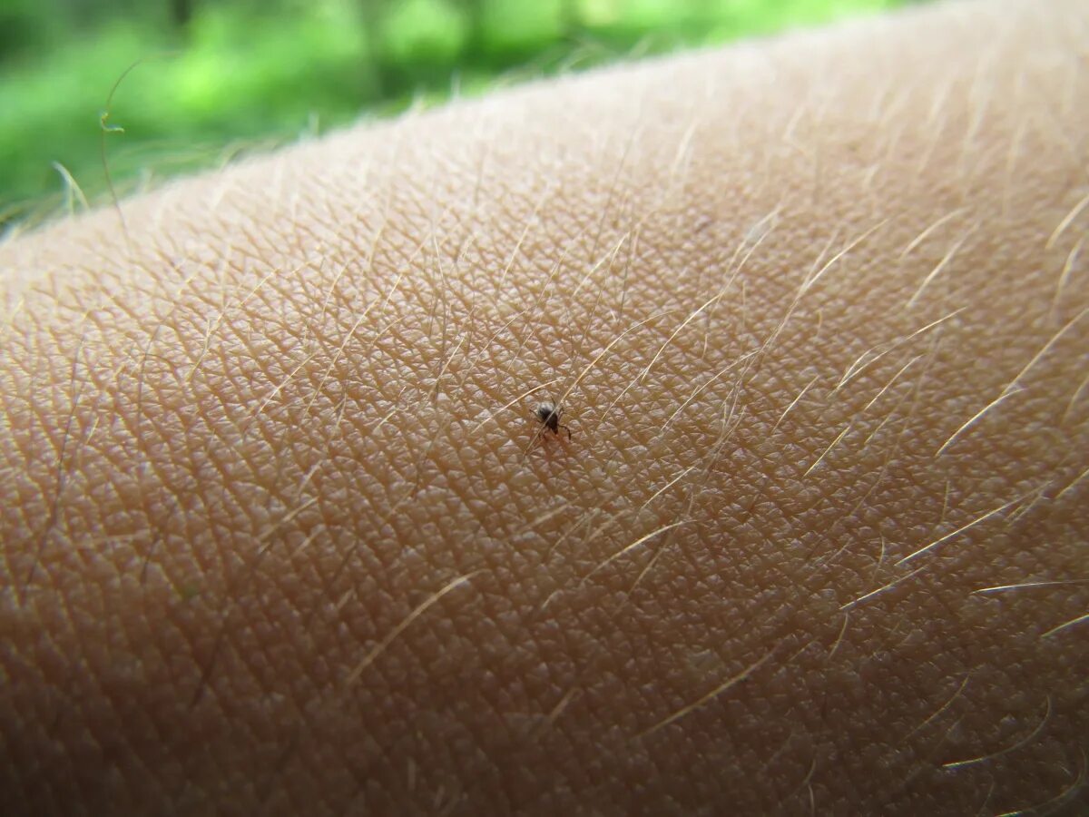 Tick bite make you allergic to. Tick bite make you allergic to