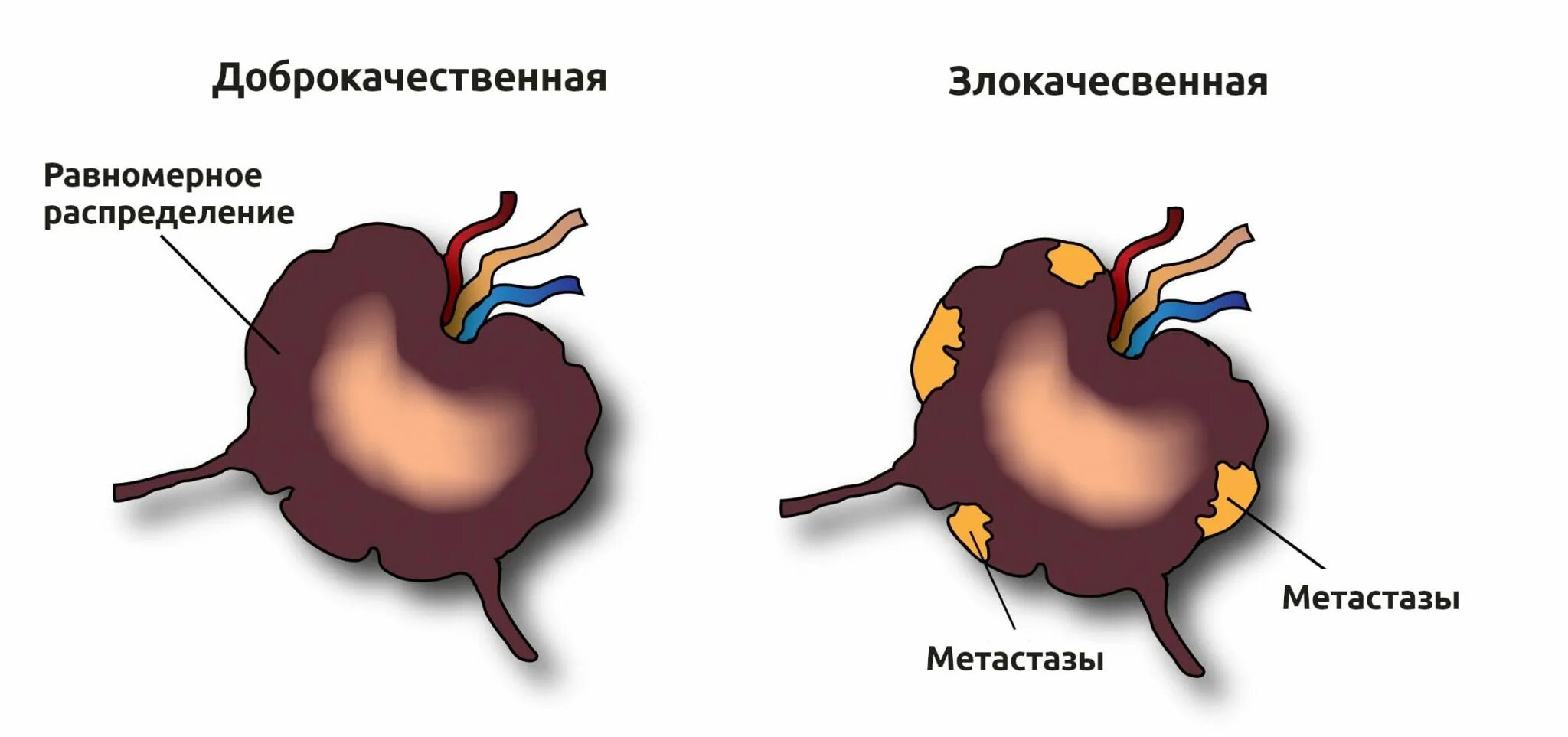 Метастаз меланомы в лимфоузел. Метастатические опухоли лимфатического узла. Метастаз меланомы в лимфатический узел. Раковые клетки в лимфоузлах. Метастазированные лимфоузлы