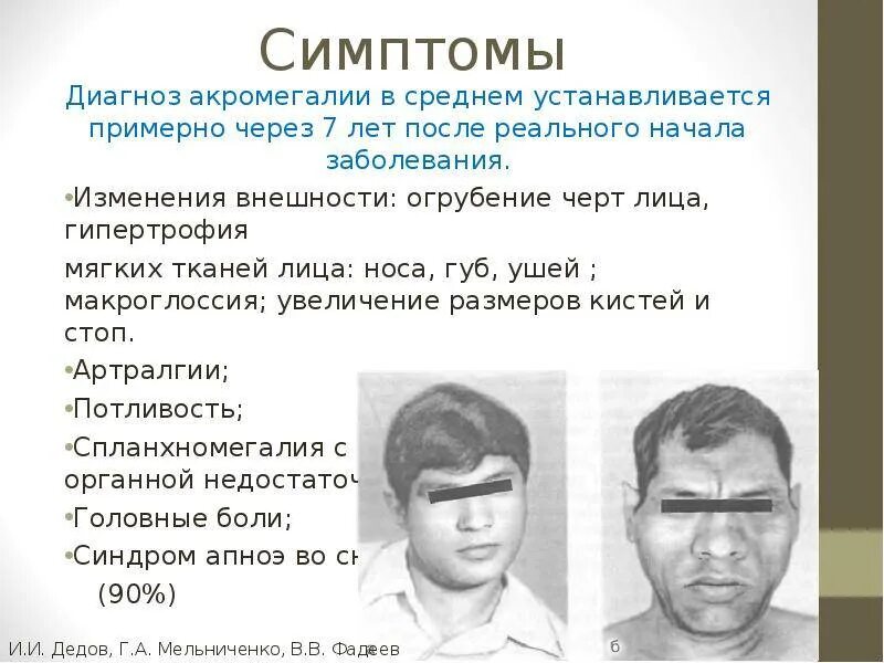 Признаками отеков являются тест. Акромегалия эндокринное заболевание. Характерные клинические симптомы акромегалии. Заболевания гипофиза: гигантизм, акромегалия. Акромегалоидные черты лица.