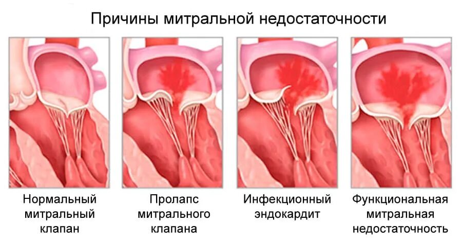 Пмк 1 степени что это такое. Пролапс митрального клапана с регургитацией 1-2 степени. пролапс митрального клапана с регургитацией 1 степени мкб. пролапс митрального клапана с недостаточностью 1 2 степени. пролапс створок трикуспидальный клапана.