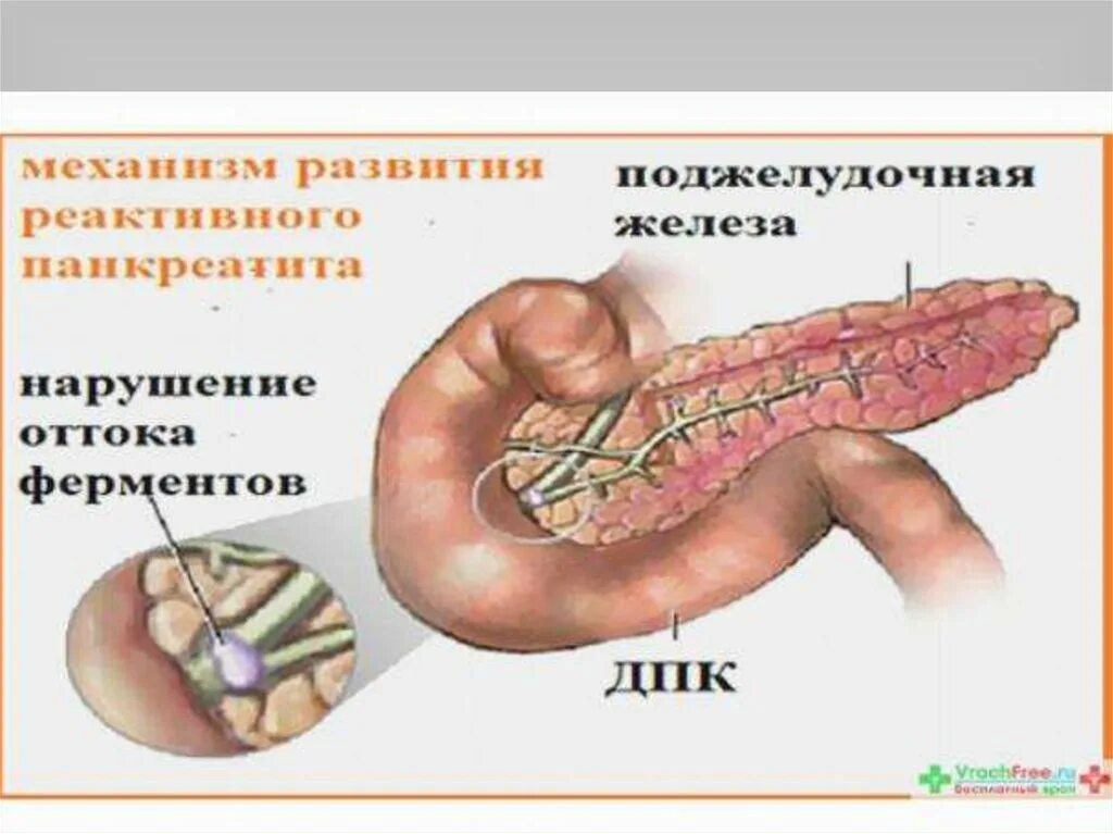 Как проявляется панкреатит. Реактивное воспаление поджелудочной железы. реактивный панкреатит этиология. симптомы панкреатита поджелудочной у детей. реактивная поджелудочная железа у ребенка что это.