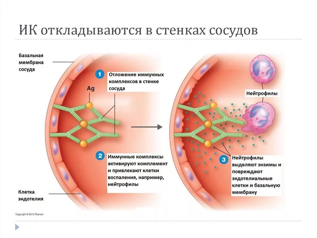 Васкулит поражение сосудов кожи. Системные васкулиты классификация. Атеросклеротическая болезнь сосудов. Поражение капилляров. Сосудистые заболевания спинного мозга.