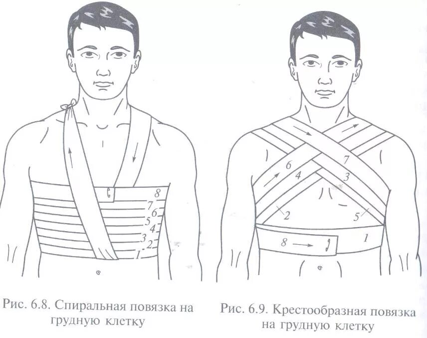 Повязка на грудную клетку алгоритм. Наложение повязки Дезо алгоритм. Бинтовая повязка Дезо. Алгоритм наложения повязки при ранении груди. Схема наложения повязки Дезо.