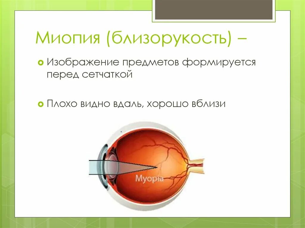 Миопия что это простыми словами. Миопия. Близорукость миопия. Миопия перед сетчаткой. Высокая миопия.