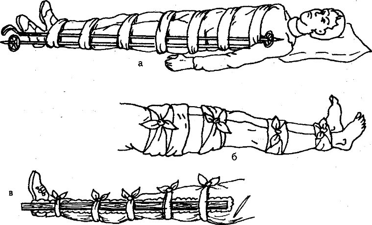 Перелом голени транспортировка. Иммобилизация при переломе голени. Иммобилизация при переломе ноги. Иммобилизация конечности при переломе бедра. Иммобилизация голени с помощью подручных средств.