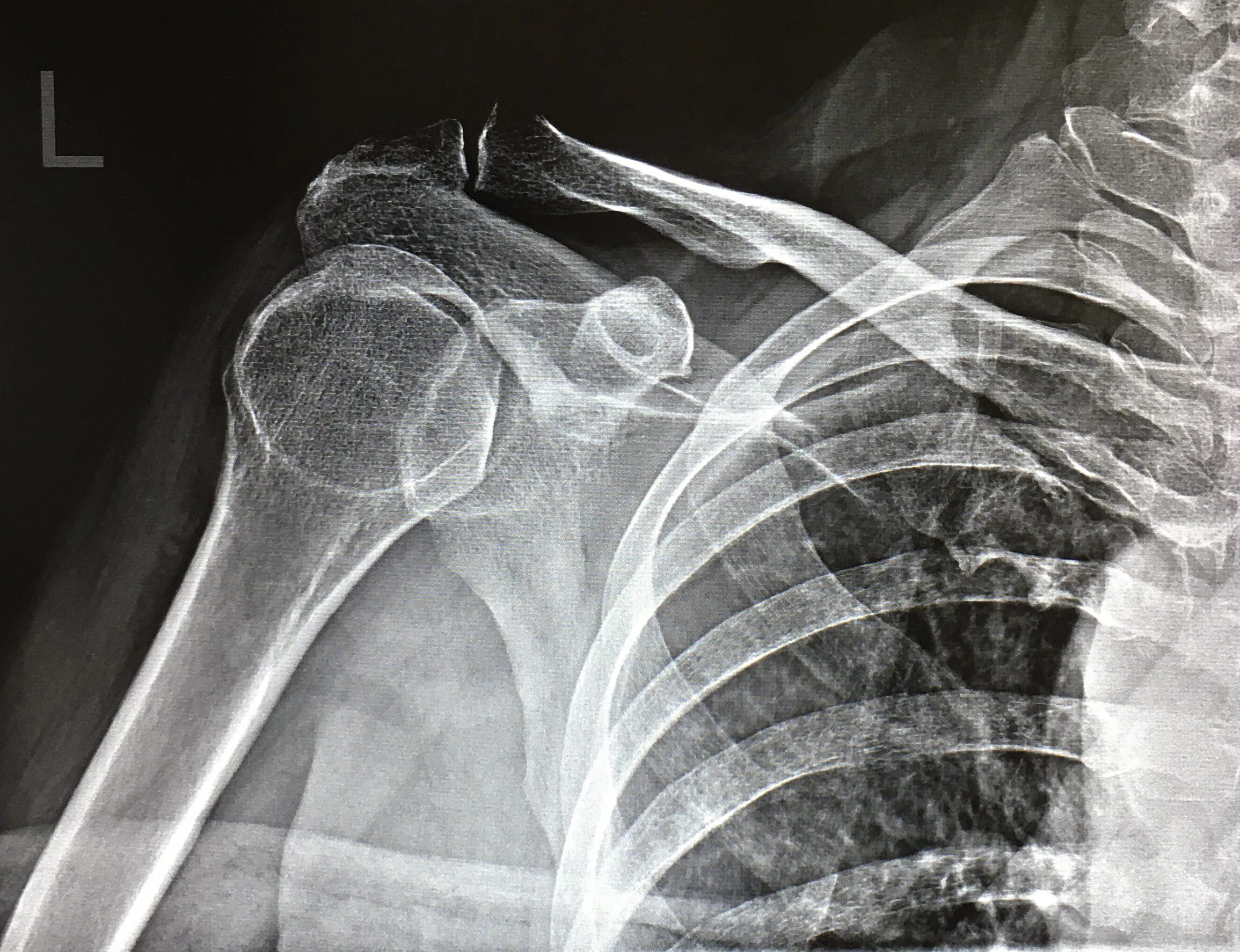 Подвывих плечевого сустава рентген. Задний подвывих плечевого сустава рентген. Плечевой сустав рентген норма. Лигаментоз плечевого сустава рентген.