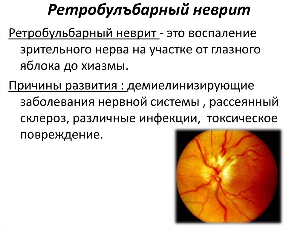 Лечение глазного нерва. Неврит зрительного нерва и ретробульбарный неврит. Неврнит зритетельного нерва. Патогенез ретробульбарного неврита зрительного нерва. Ретробульбарный неврит глазное дно.