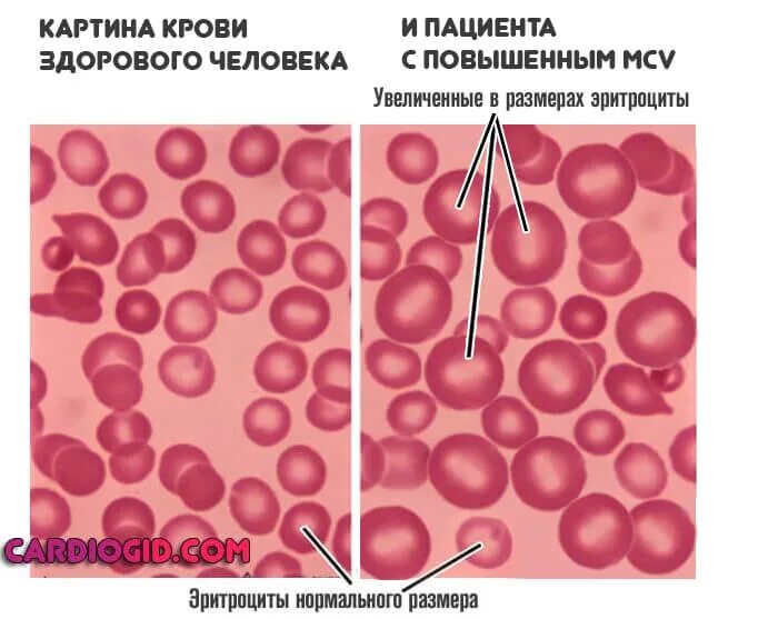 Эритроциты сильно повышены. Микроцитоз и макроцитоз. Нормальные эритроциты. Эритроциты объемное. MCV эритроциты.