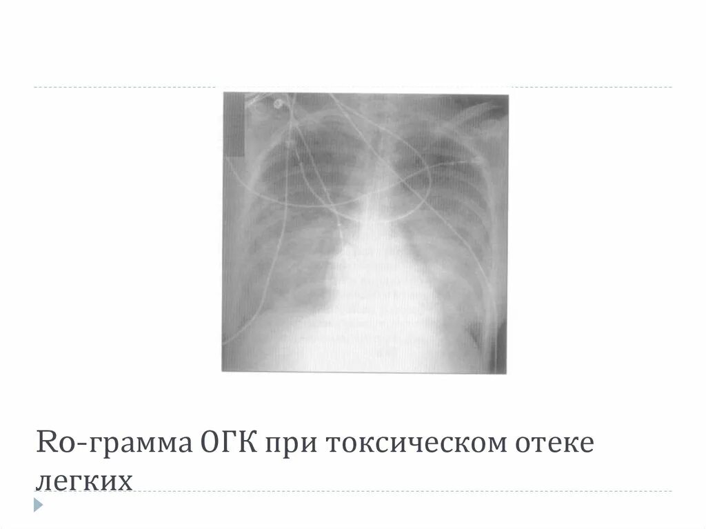 Как выглядит отек легких. Токсический отёк лёгких. токсический отёк лёгких рентген. интоксикационный отек легких рентгенограмма. токсический отек легких при.