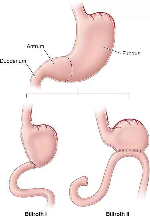 Хронический гастрит тела желудка. Антральный отдел желудка гастрит. Антрум гастрит это. Гастрит тела и антрального отдела желудка. Хронический атрофический мультифокальный гастрит.