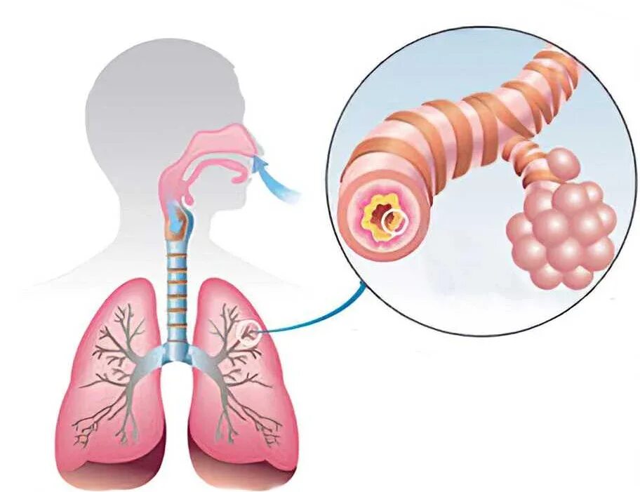 Слизисто гнойный бронхит мокрота. Обструктивный и необструктивный бронхит. Острая мокрота. Характер мокроты при остром бронхите. Острая мокрота.