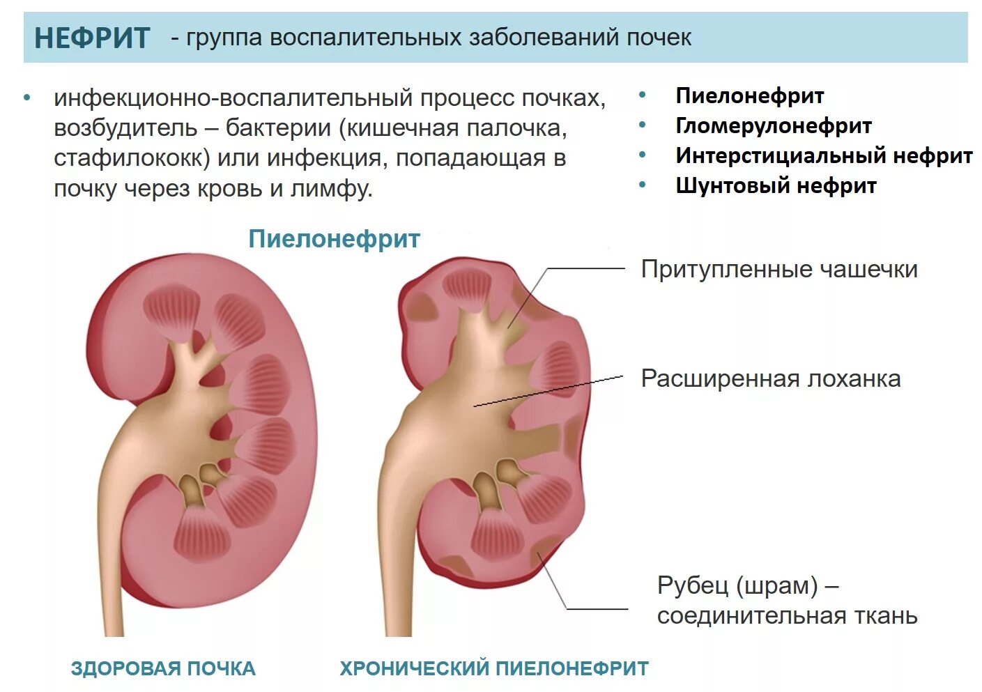 Гломерулонефритом страдают. Хронический пиелонефрит поражение почек. Пиелонефрит с нарушением выделительной функции почек. Болезни почек пиелонефрит гломерулонефрит. Нефрит пиелонефрит гломерулонефрит.