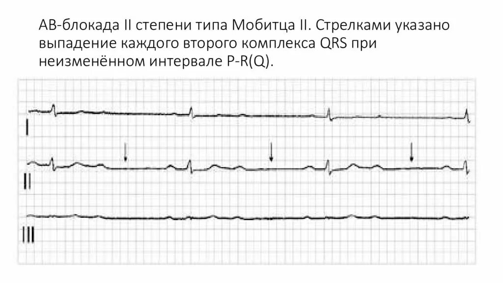 Комплекс блокада. Блокада 2 степени на ЭКГ. АВ блокада 2 степени Мобитц 1 на ЭКГ. Синоатриальная блокада Мобитц 1 ЭКГ. АV блокада 2 степени на ЭКГ.