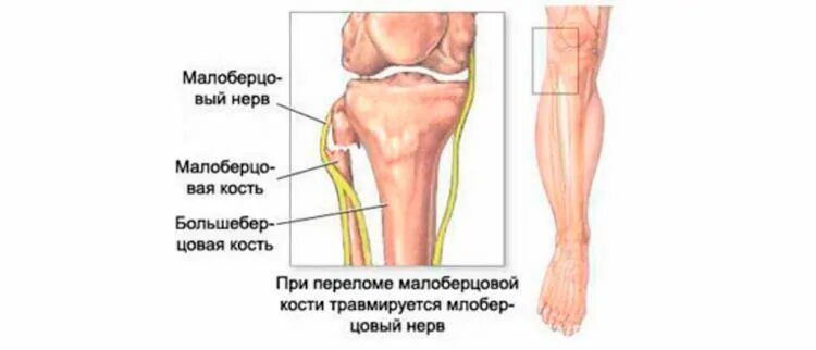 Аксональное поражение малоберцового нерва. Мононейропатии малоберцового нерва. Невропатия большеберцового нерва. Гипестезия малоберцового нерва. Малоберцовый нерв анатомия.