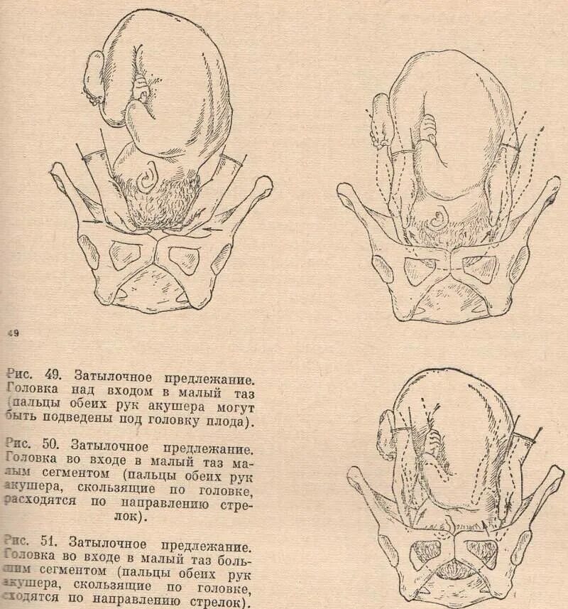 Ребенок опустился в таз. Головка плода опустилась в таз. Затылочное предлежание. 39 недель головка