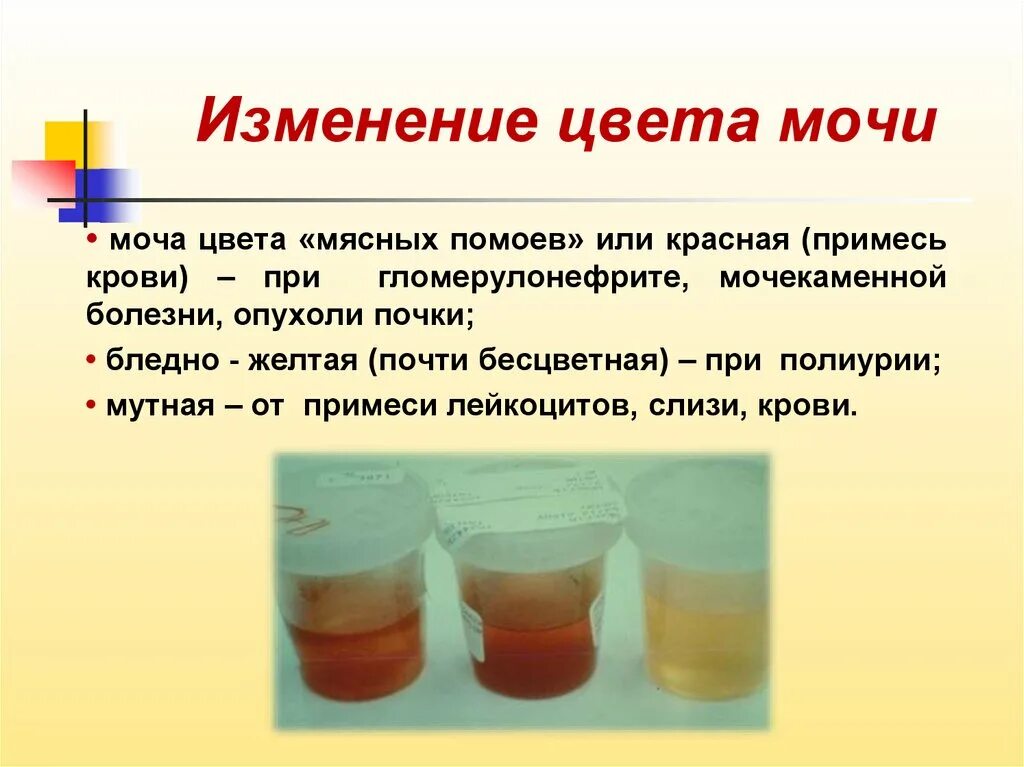 Темная моча у женщин. Моча цвета мясных помоев. Цвет мясных помоев цвет мясных помоев. Изменение цвета мочи. Цвет мчных помоев иочи.