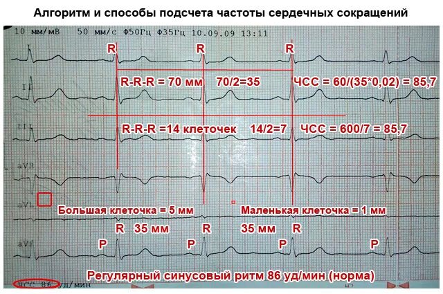 Платные услуги экг. Подсчет ЧСС на ЭКГ. Формула подсчета ЧСС на ЭКГ. Подсчёт ЧСС по ЭКГ 50 мм. ЭКГ расшифровка ЧСС формула.