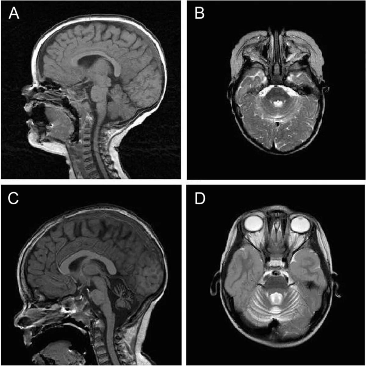 Мрт большеберцовой кости. Асептический некроз бедренной кости кт. Импрессионный перелом мрт. Магнитно-резонансная томография суставов (голеностопного сустава). Туберкулез подвздошной кости на кт.