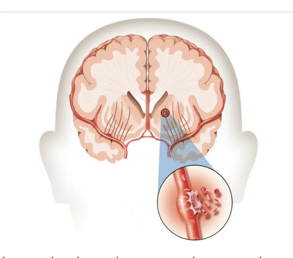Геморрагический инсульт головного мозга. Причины геморрагического инсульта головного мозга.