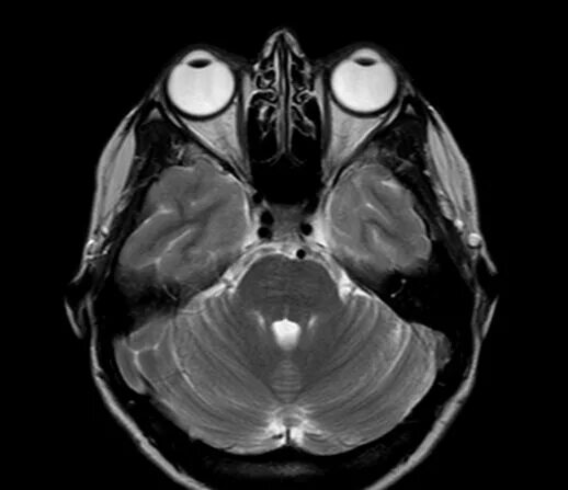 Мрт орбит и зрительных нервов. Магнитно-резонансная томография орбит. Кт глазных орбит и зрительных нервов.