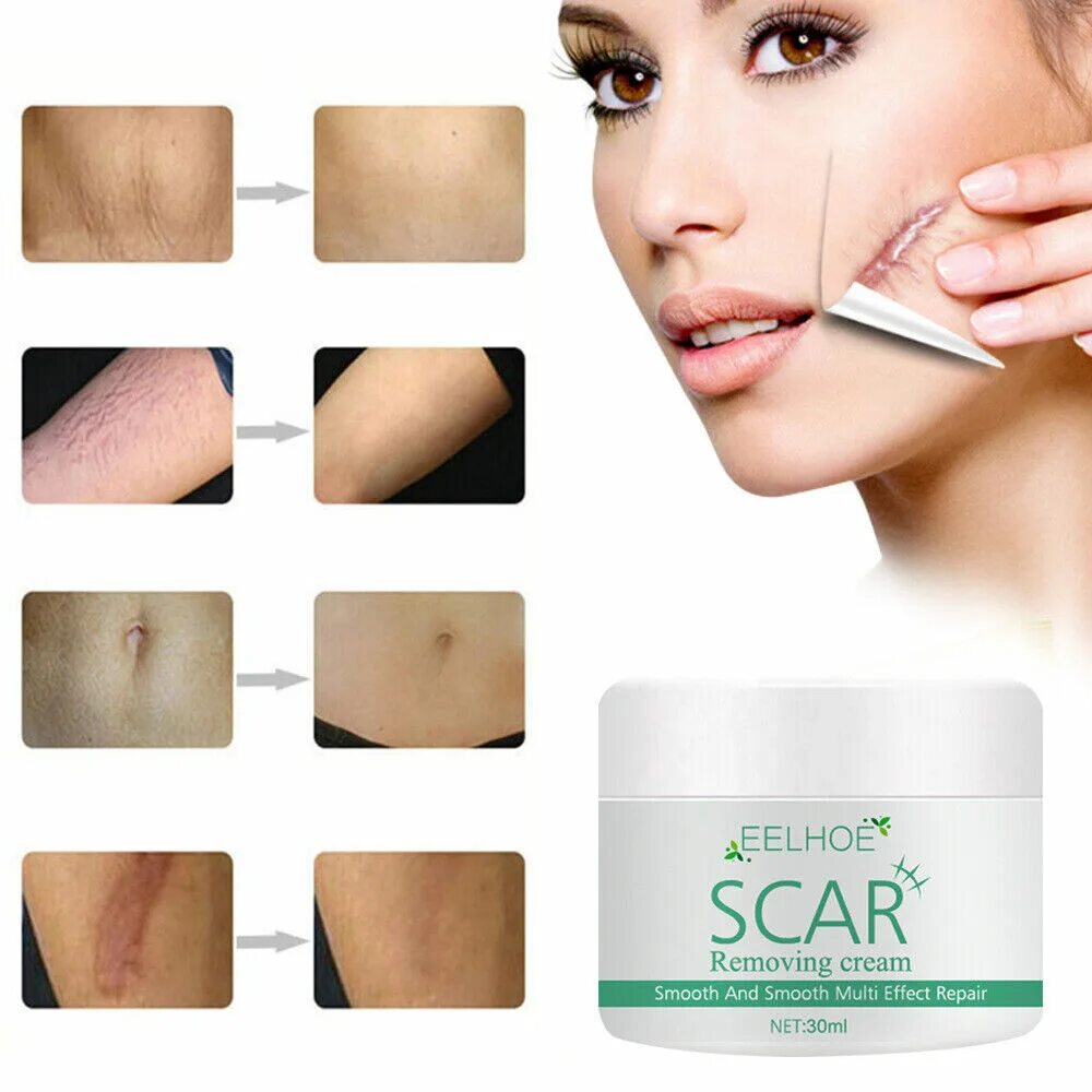 Крем ланбена. Lanbena tcm scar and acne mark removal gel ointment. Lavender scar repair cream китайский крем. Lanbena tcm scar and acne mark removal gel ointment. Mark removal.