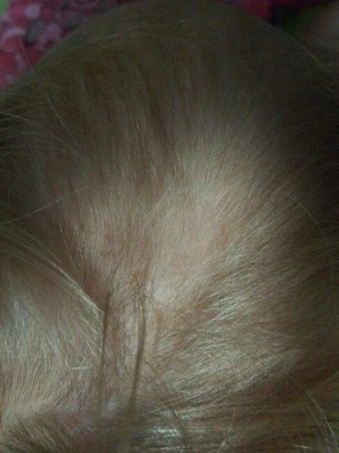 Выпадение волос у детей 8 месяцев. Ребенок 5 месяцев выпадают волосы. У ребёнка 5 лет выпадают волосы. Выпадение волос 5 месяцев ребенку.