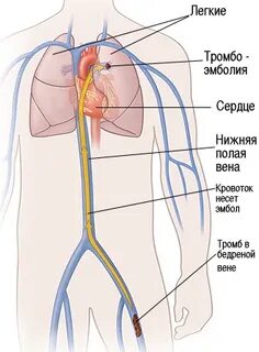 Тромбы полостей сердца
